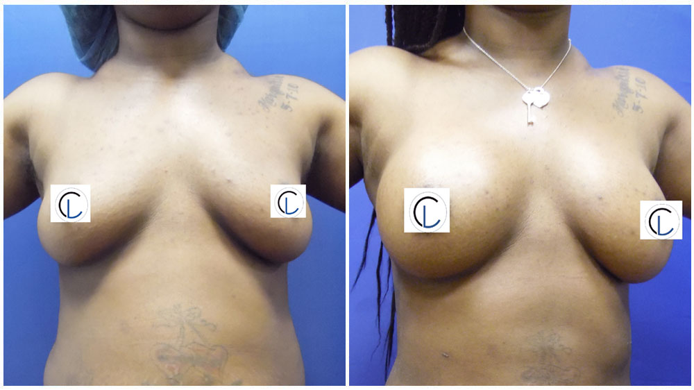 Saline Implants - Breast Enhancement Patient